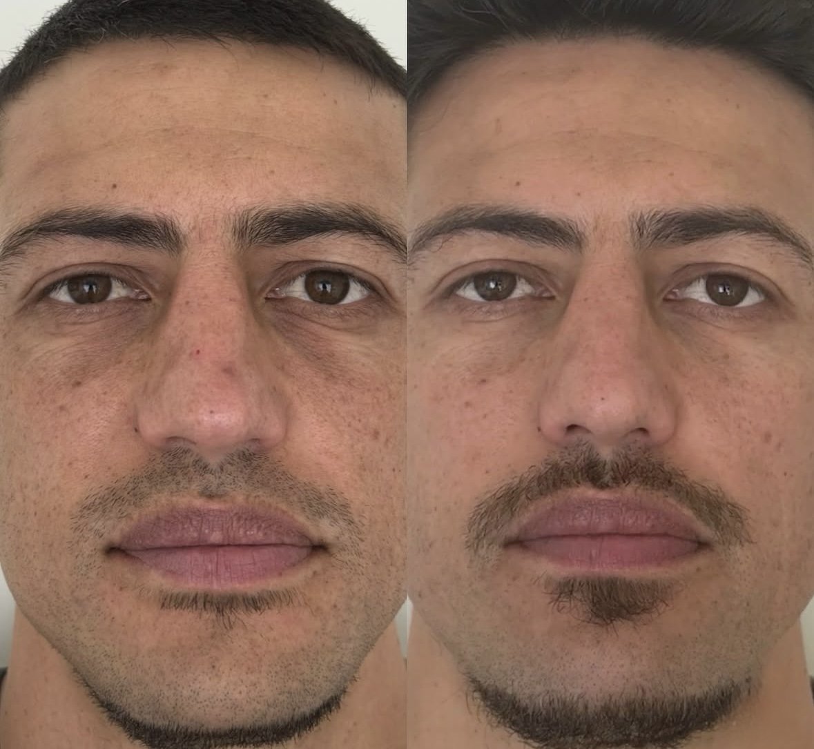 Under-eye and skin treatment before and after, male client, Maroon Door Aesthetics Auckland