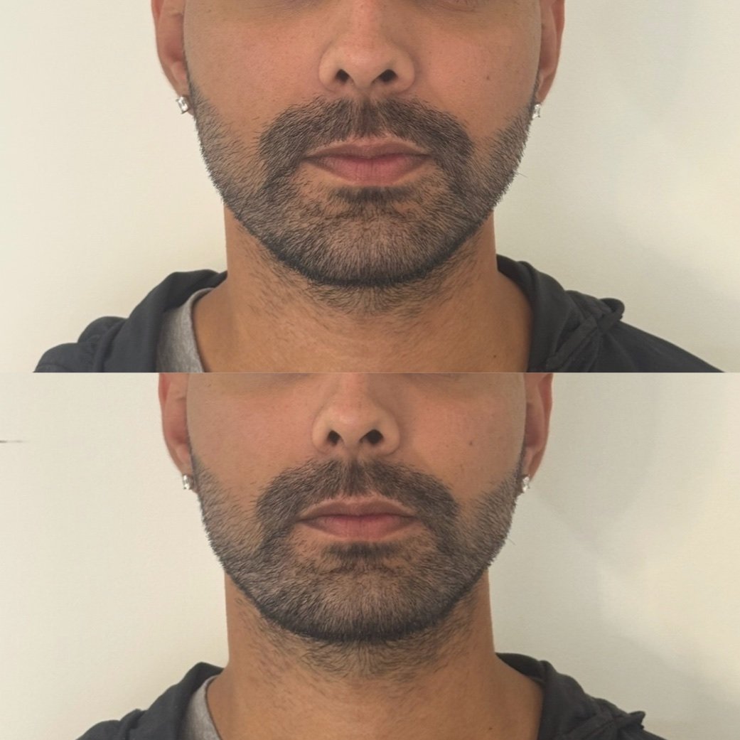 Jawline filler before and after, male client, Maroon Door Aesthetics Auckland